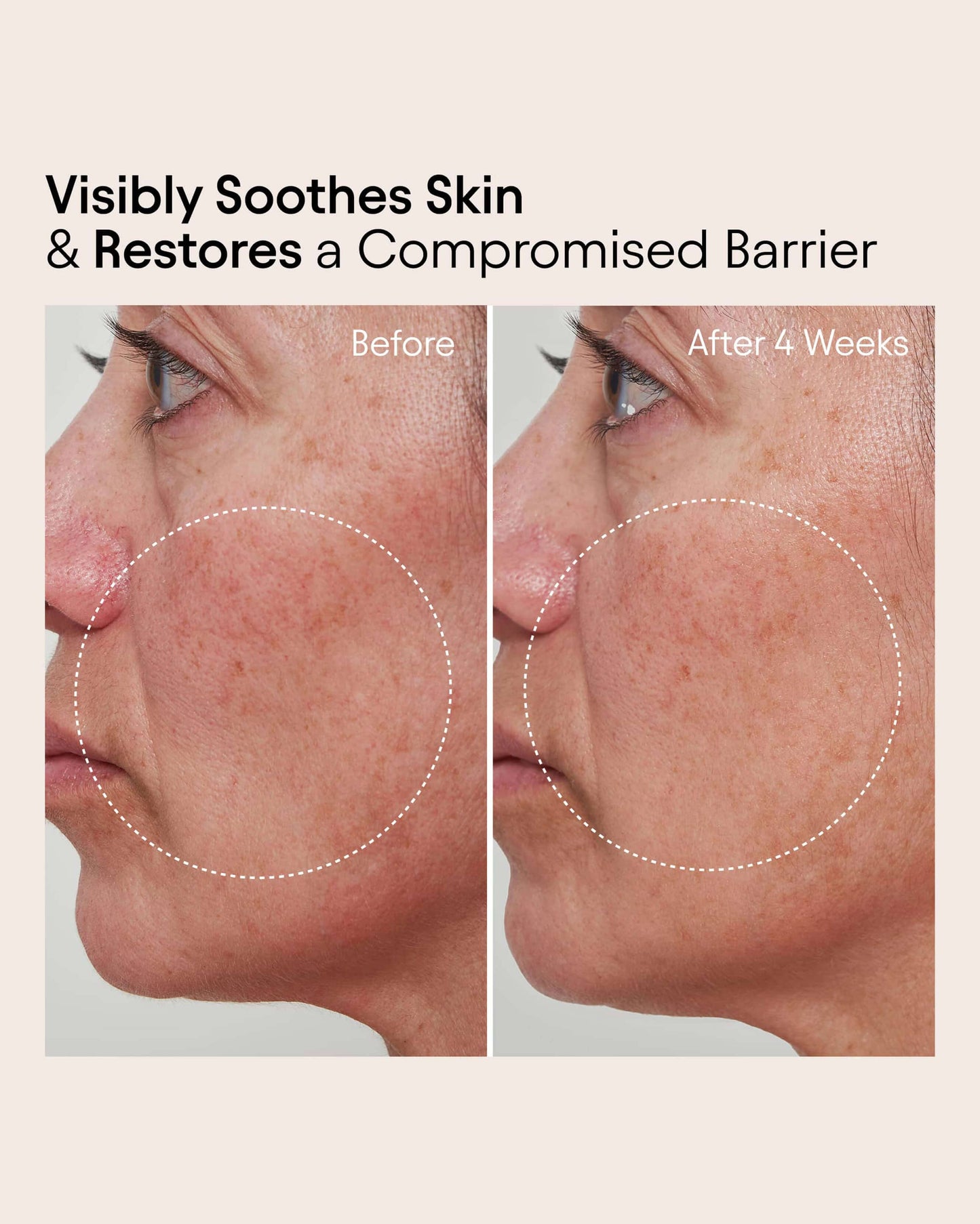 Barrier Repair Cream Moisturizer for Eczema, Barrier and Wrinkle Repair